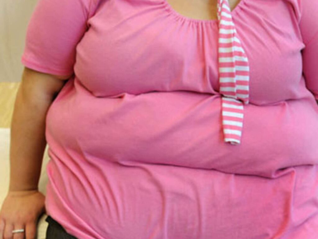 Obstructive apnea.. Obesity surgeries reduce the risk of death