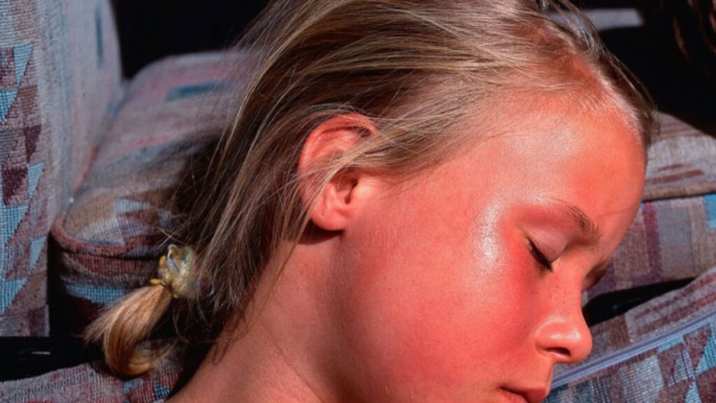 Sunburns.. When do you need to consult a doctor?