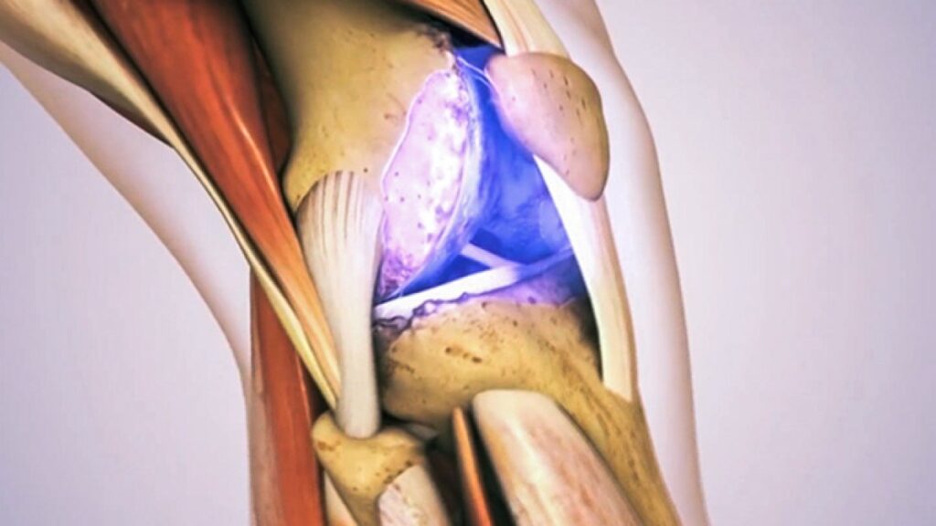 "dancing particles" Treats cartilage damage