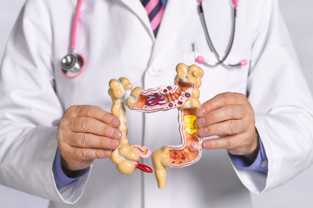 The best way to reduce your risk of colon cancer