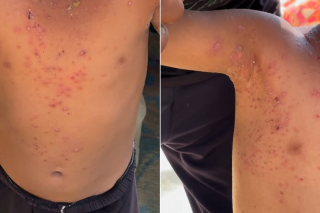 Watch.. Skin diseases ravage the bodies of Gaza children