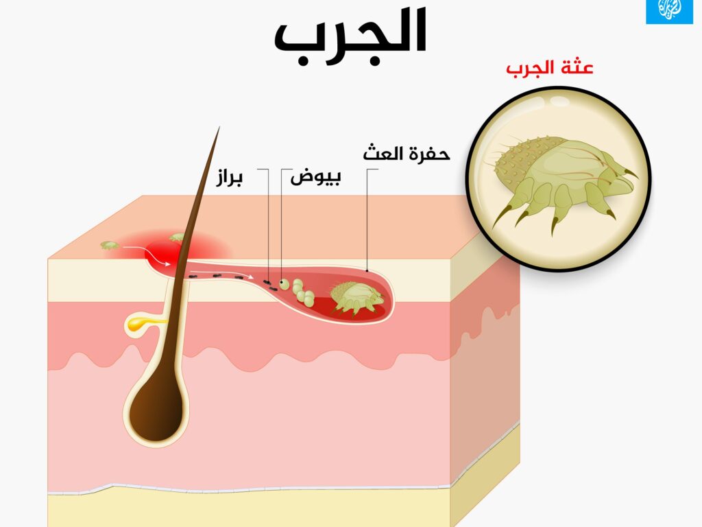 Scabies is a disease known as scabies.. Symptoms and treatment