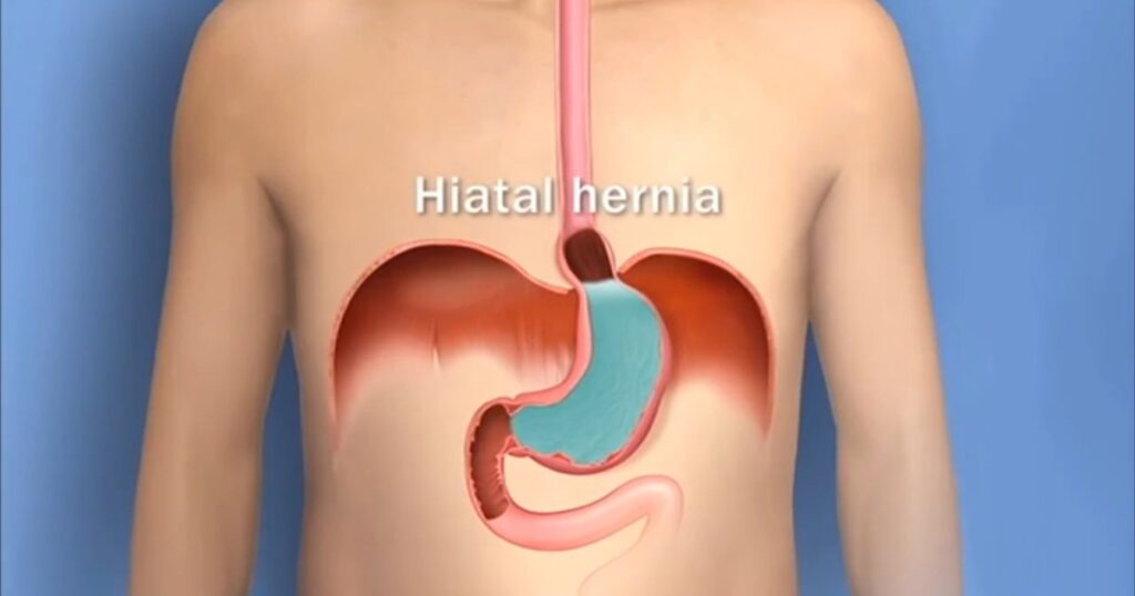 Acidic and persistent burping is a sign of heartburn.