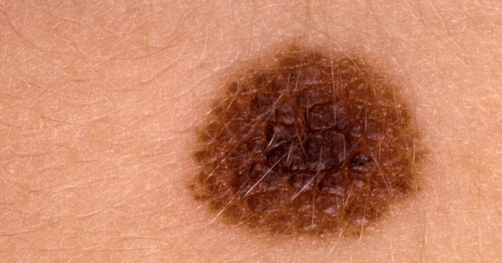 Mobile phones may play a role.. Sweden is the first European country to witness a decline in skin cancer among young people