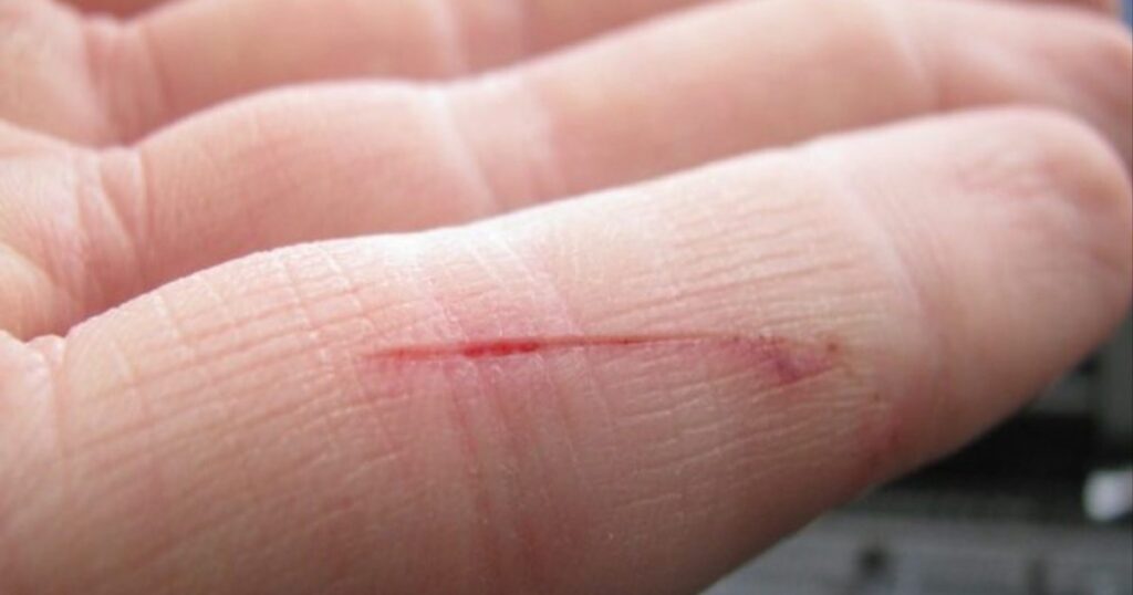 New technology "Light up" Bacteria in wounds and helps get rid of them