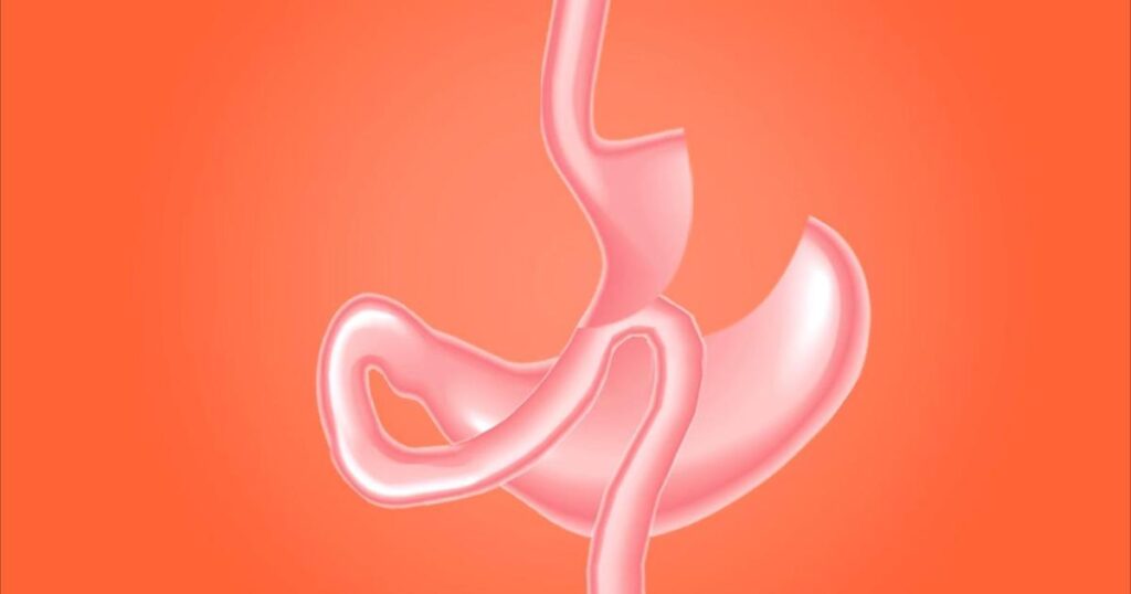 Study reveals that obesity surgery is superior to Ozempic in protecting the kidneys