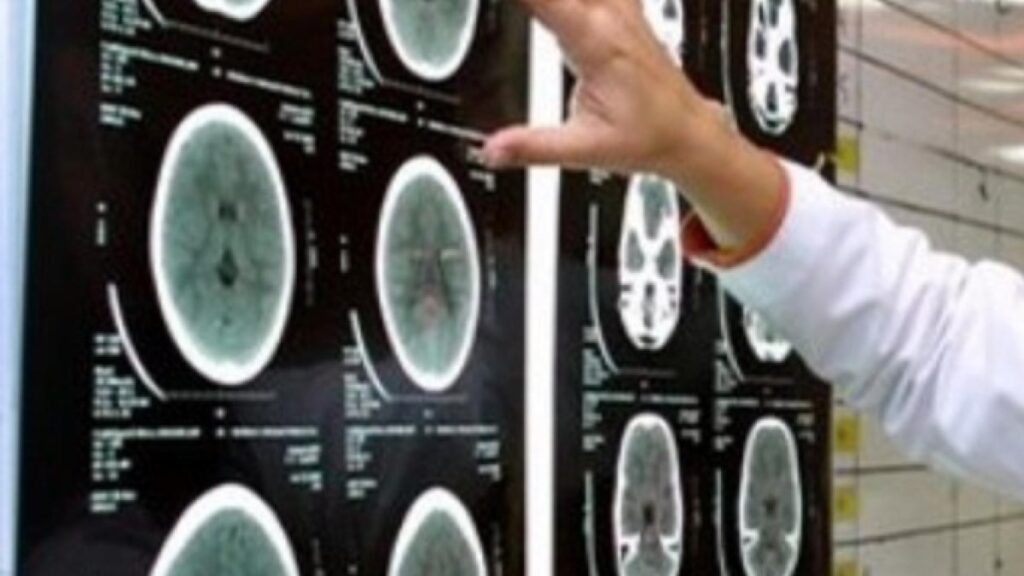 Advances in understanding glioblastoma brain cancer