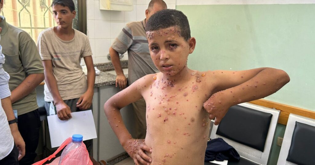 Rare skin diseases appear in Gaza
