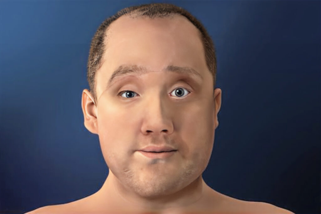 50 hours of surgery...a face transplant for an American man