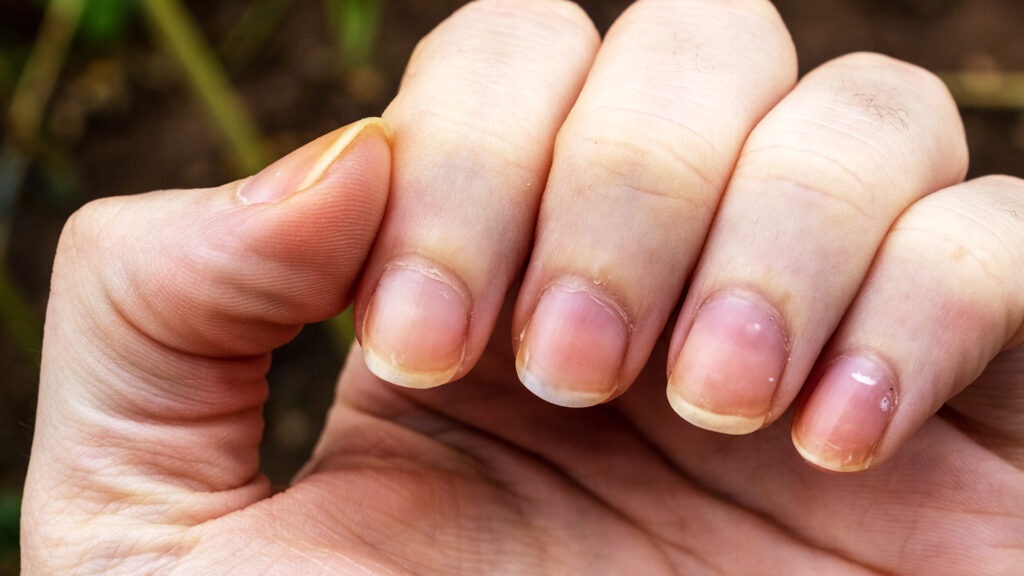 3 signs of nail fungus