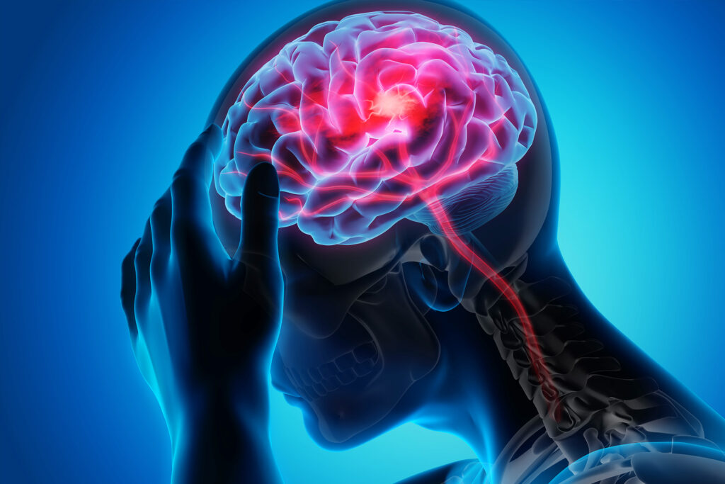 Why are the effects of stroke more severe for some?