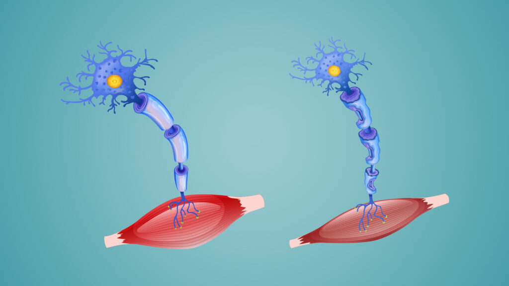 Heart disease increases the risk of amyotrophic lateral sclerosis