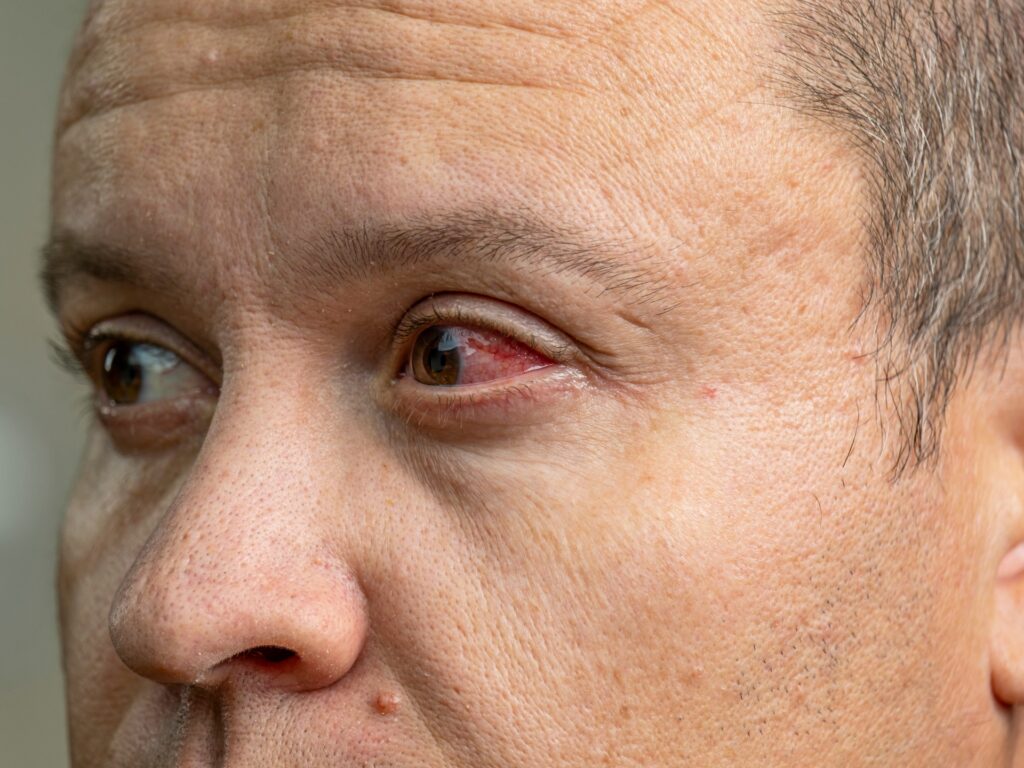 An urgent warning to travelers about the outbreak of an infectious disease that causes eye bleeding