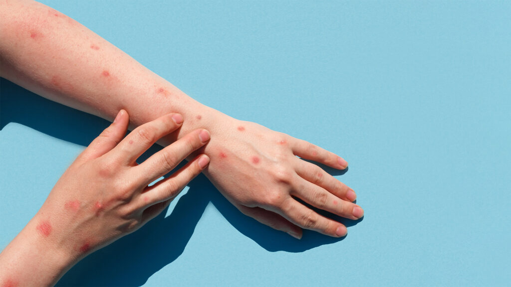 Warning after discovering a strain "Clyde 1B" Of the monkey chickenpox in the United Kingdom