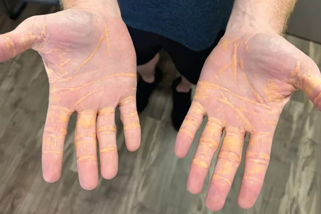 Watch .. cholesterol leaks from American skin in Florida