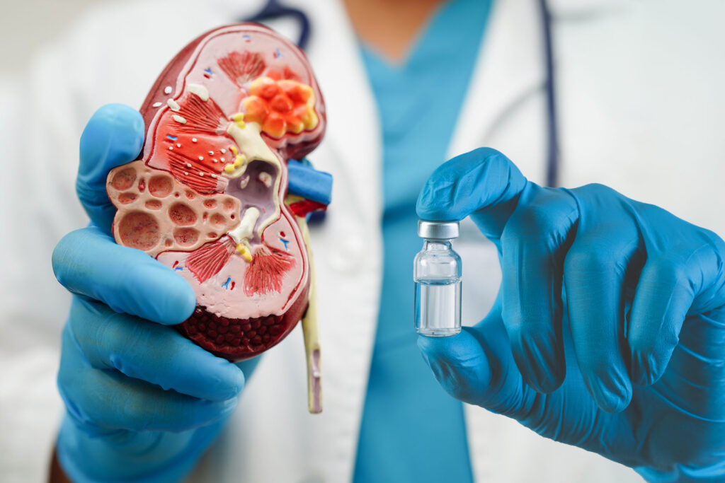 A kidney cancer vaccine gives patients to patients not to return the disease