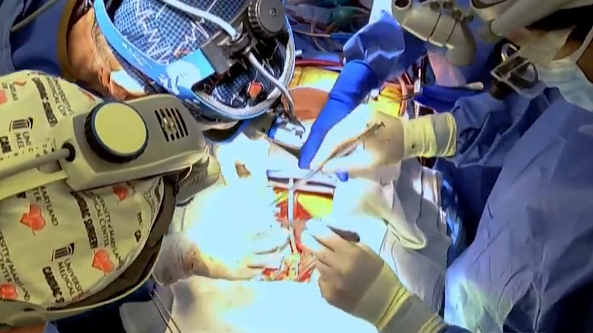 This is what we know so far about the transfers of organs from the pig to humans