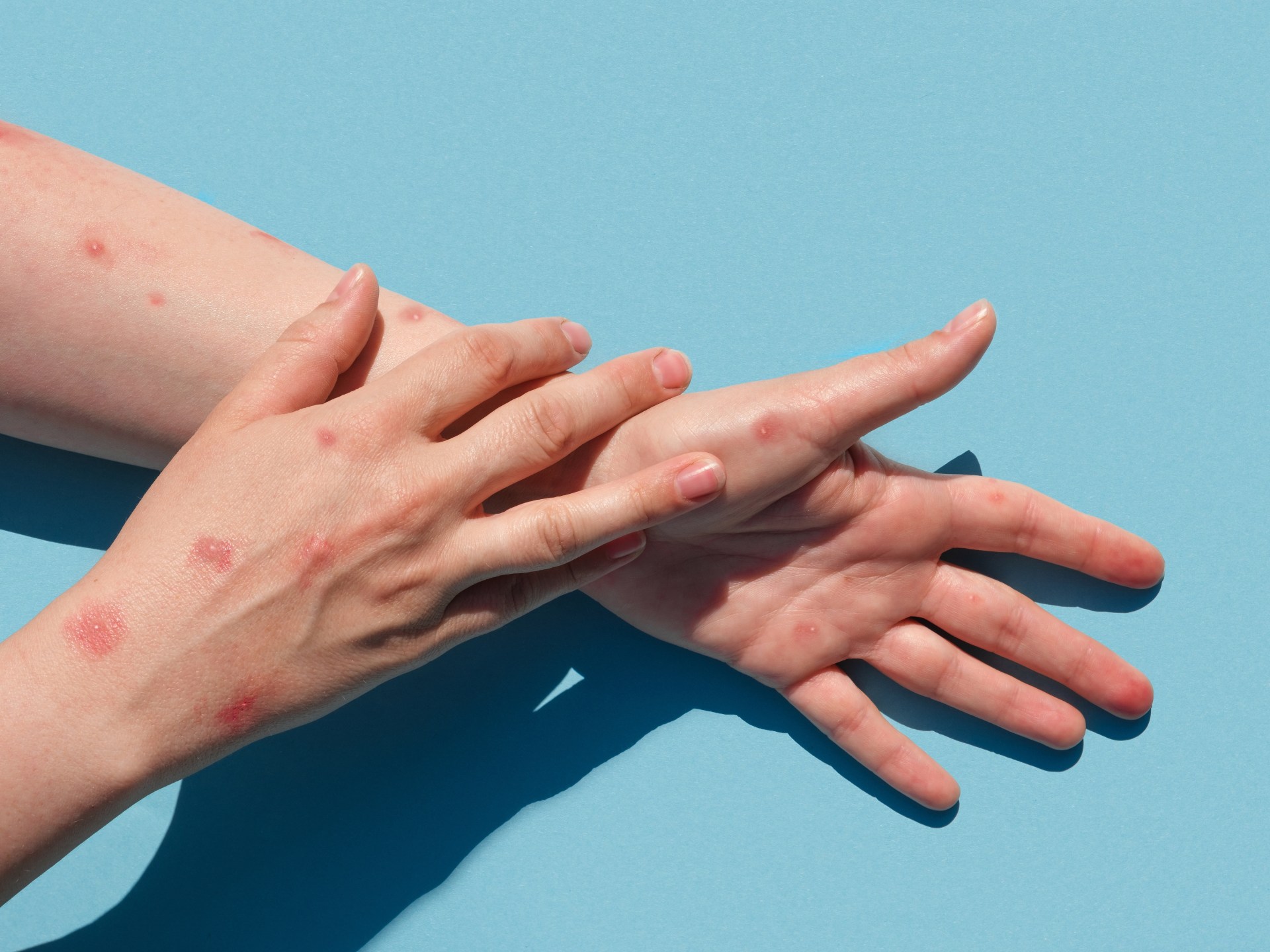 World Health Organization: Apesus is still a healthy emergency