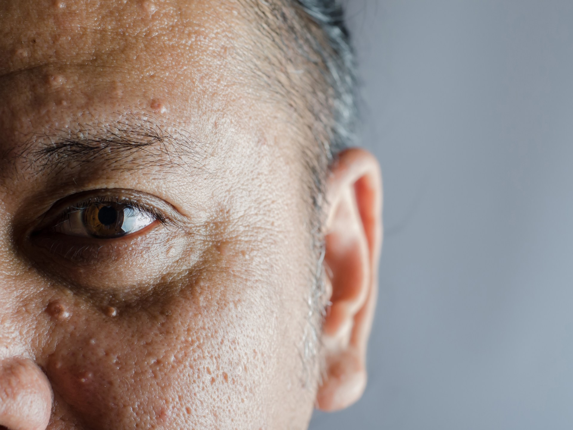 Signs that should not be ignored indicate that the lens of the eye