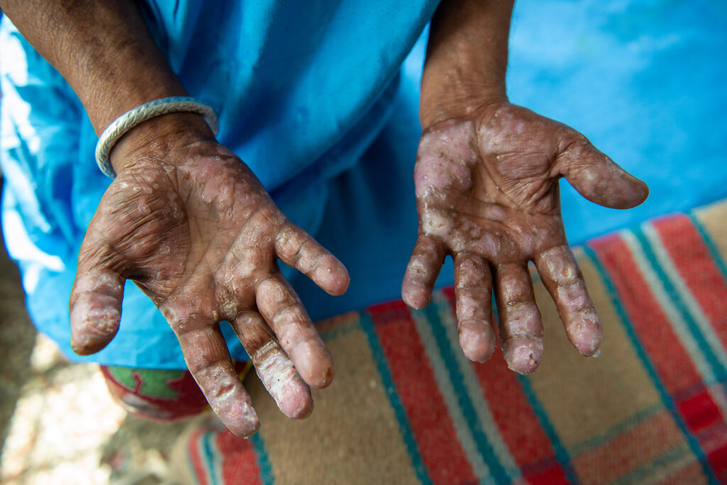 Nigeria gets leprosy treatment a year after its interruption