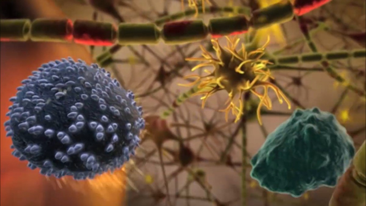 virus "Epstein Bar" Human genes are allied to cause multiple sclerosis