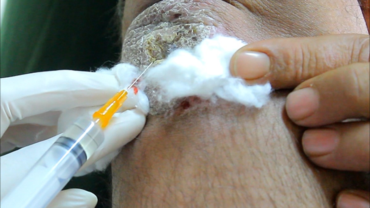 Researchers discover a way to successfully predict the treatment of parasitic skin disease