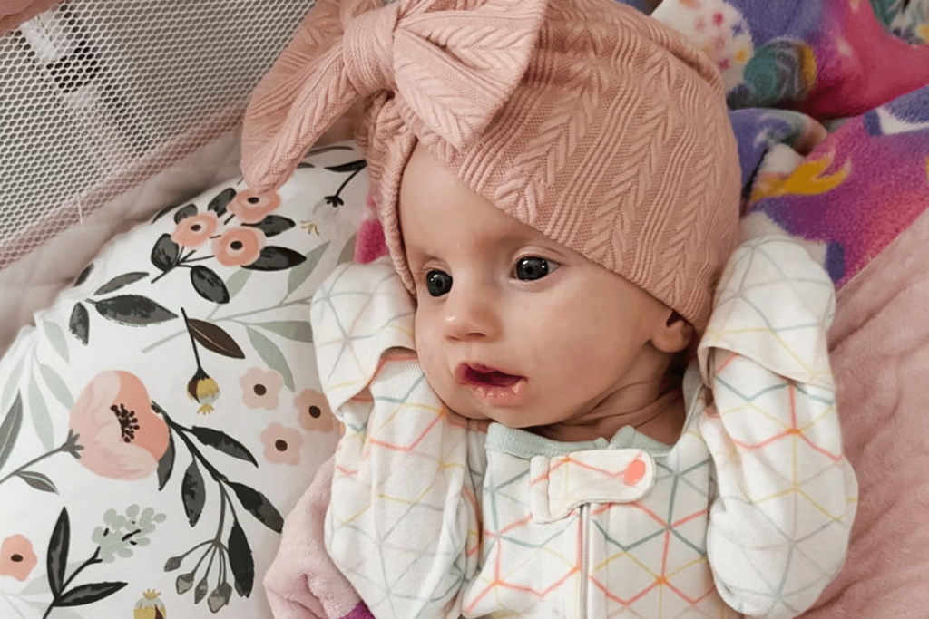 Rare syndrome prevents an infant from eyelashes or smiling