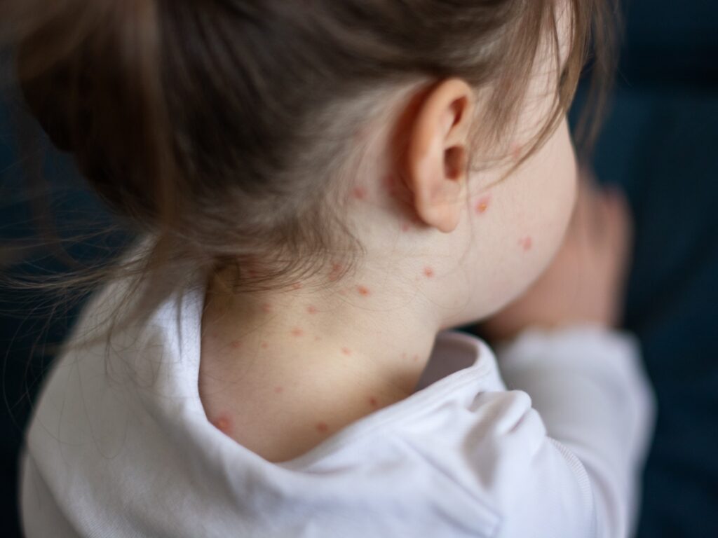 Measles causes the death of a second child in Texas, USA
