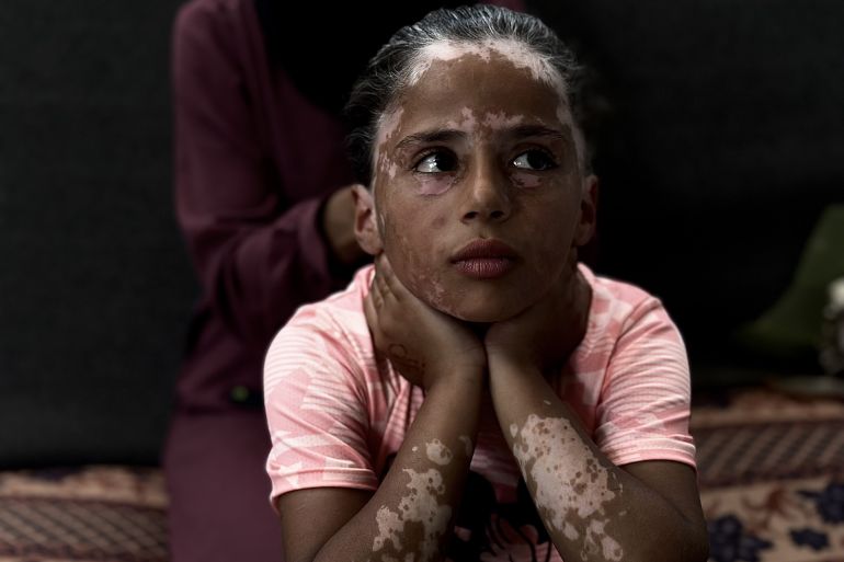 Inside a worn tent on the outskirts of one of the displacement camps in the city of Khan Yunis, southern Gaza Strip, the Palestinian girl, Lana Al -Sharif, sits clinging to the rest of her childhood after 19 months of the genocide war committed by Israel, during which she lived harsh shocks and lost most of her rights. The pink shirt that the honorable pink shirt and printed the cartoon character "Mickey Mouse", did not succeed in adding a little joy to her features, which seemed to be saddened after her body was moderated with white bears similar to "Vitiligo", according to the appreciation of doctors in Gaza. Through a small mirror, the honorable girl contemplates her shape, which was changed by the continuous Israeli genocide, as she invaded her "white graying" hair, and she did not exceed her ten years due to her exposure to extreme fear. (Doaa Albaz - Anatolia Agency)