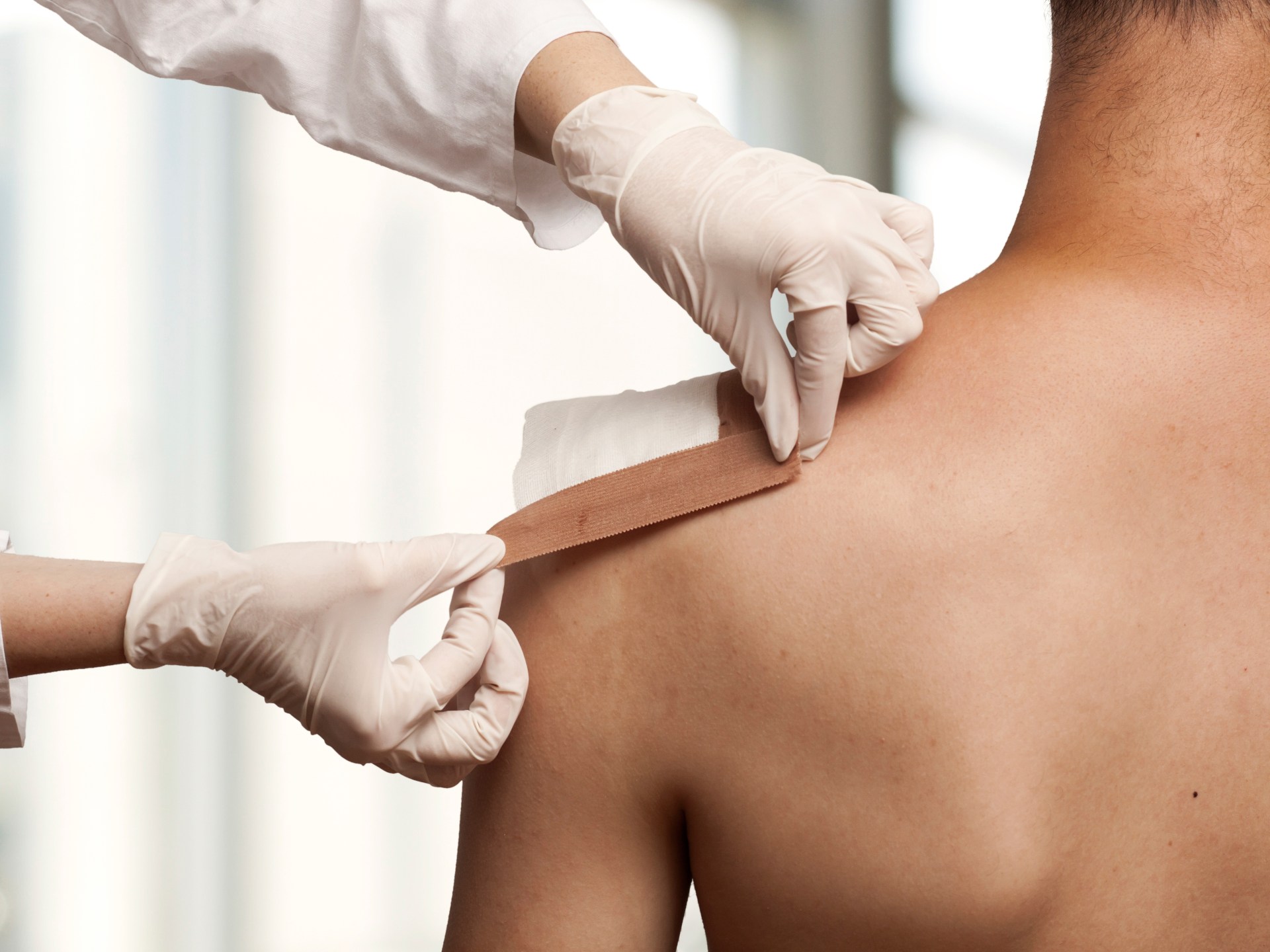 A new generation of skin alternatives that gives hope to patients with burns