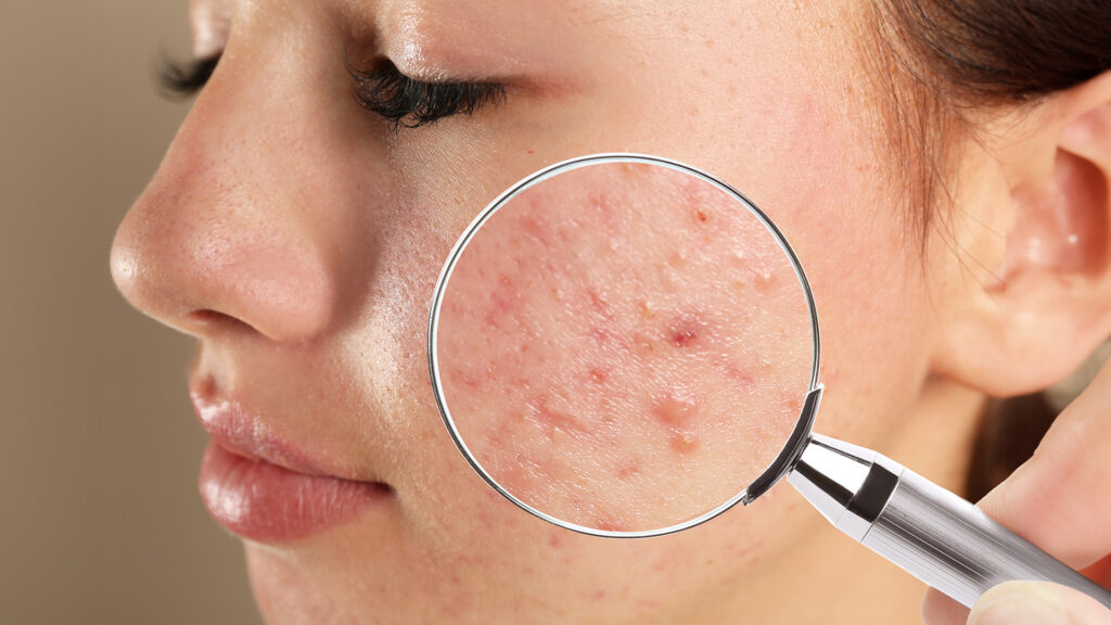Adults with acne are increasing