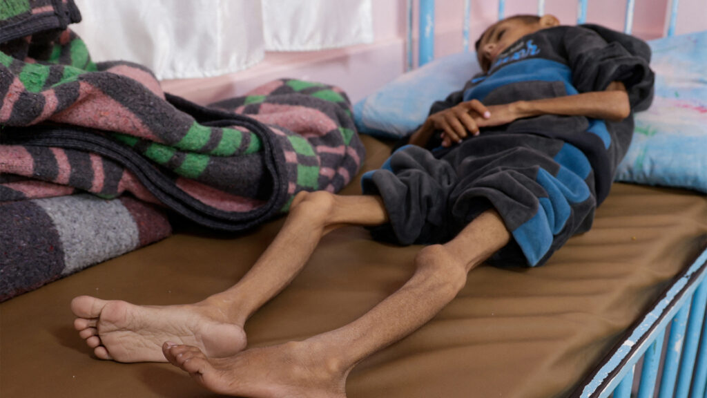 British surgery: Gaza children suffer from the difficulty of healing their wounds due to their lack of vitamins and minerals