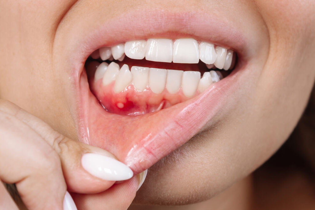 Continuous oral ulcers may vow oral cancer