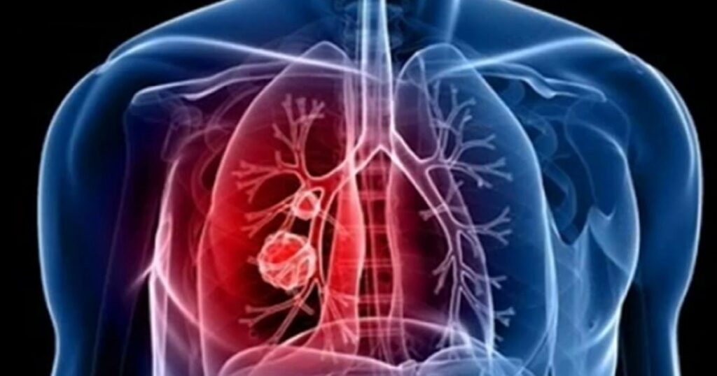 Simple symptoms may be an early sign of lung cancer