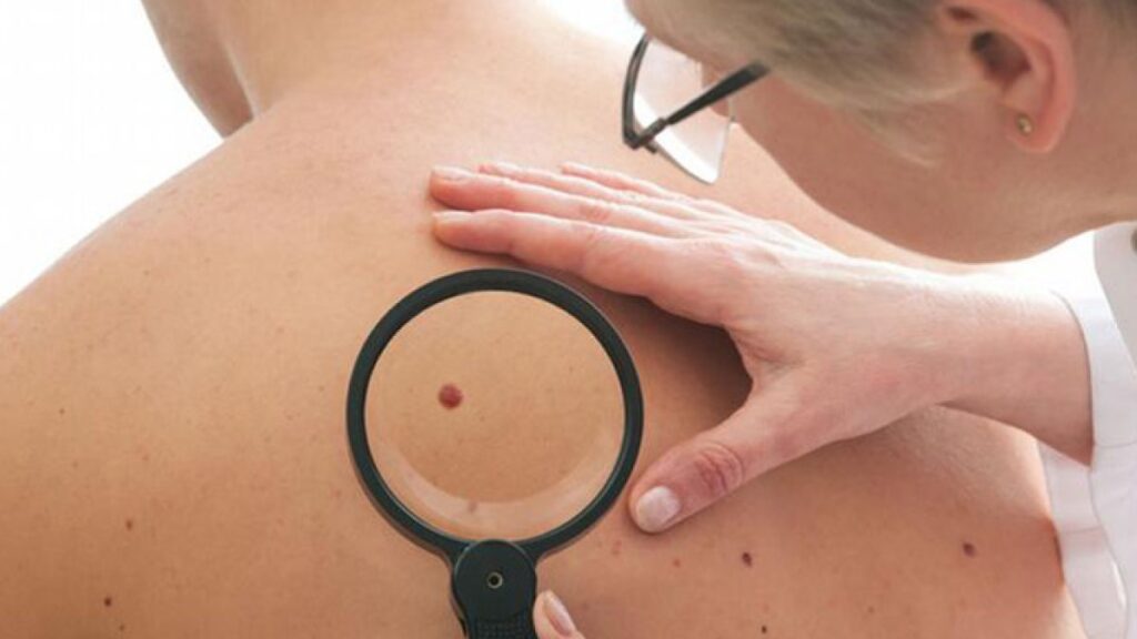 Treatment that is used once helps skin cancer patients to live for a longer period