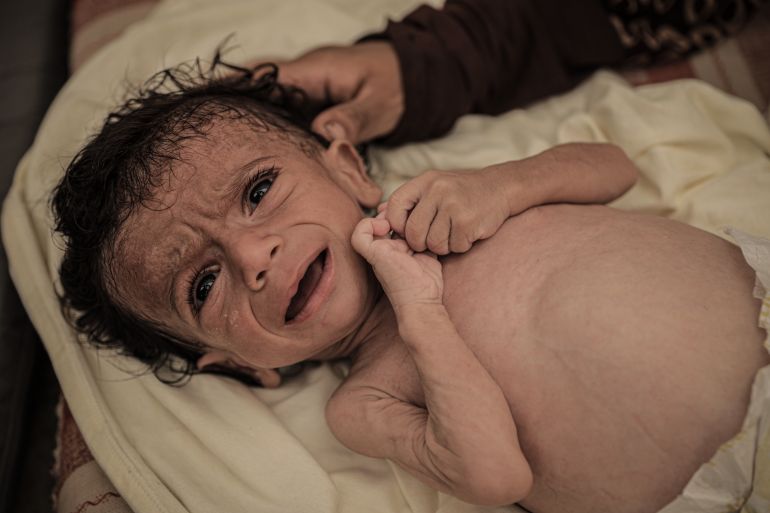 Gaza City, GAZA-July 26: Seven-Month-ILD Salim Mahmoud Awad Selffers Signics Weight Loss Due to the Lack of Baby Formula and Food Education Display to Gaza City, Gaza With his Family, on July 26, 2025. Strugling with Malnutrition, The Infant's Health Continues to Deteriorate as ISRAEL's Strict Blockade on the Gaza Strip Pose a Serious Threat to the Lives of Infants. (Ahmed Jihad Ibrahim Al -Arini - Anadolu Agency)