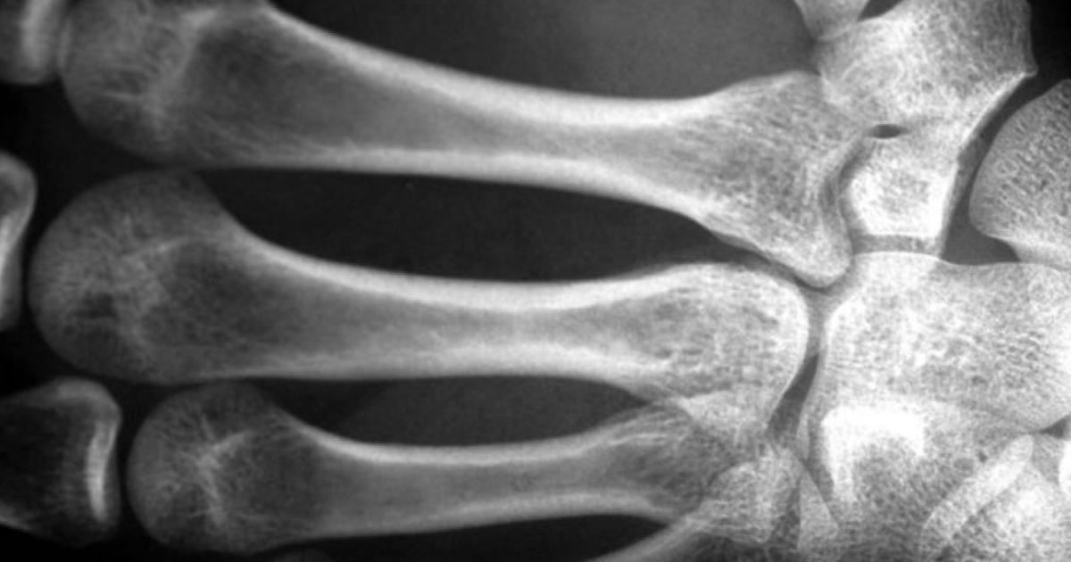 Is bone health an anxiety for men?