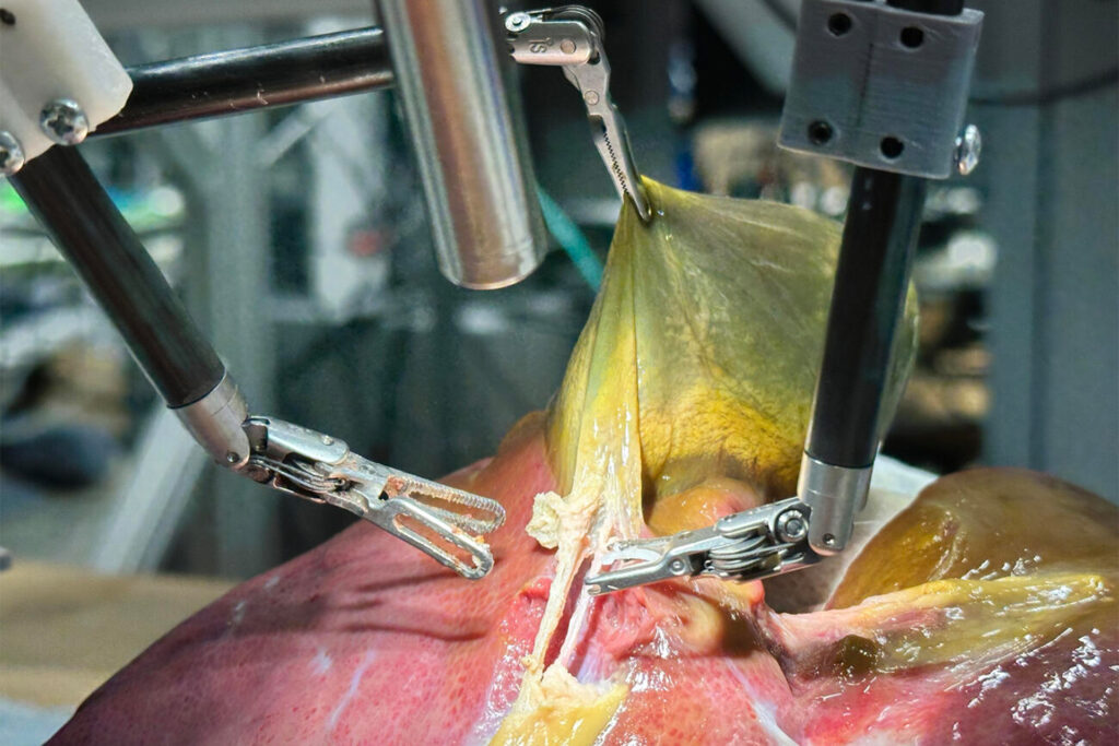 Watch .. a surgical robot performs the first surgery without human intervention