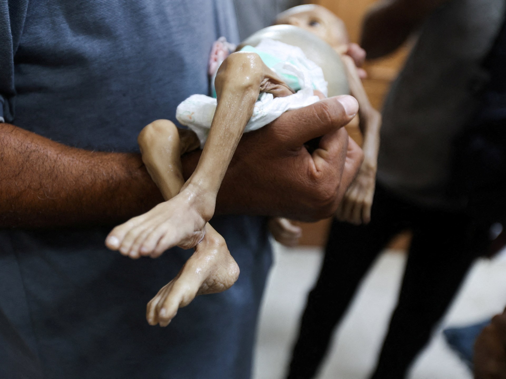 3 deaths and 95 infections of the rare Ghaylan Barre syndrome in Gaza due to starvation