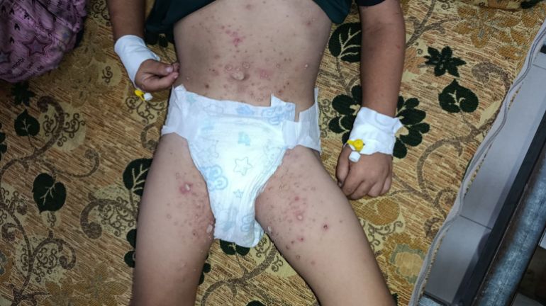 A child suffering from a severe and painful rash receives a vein treatment