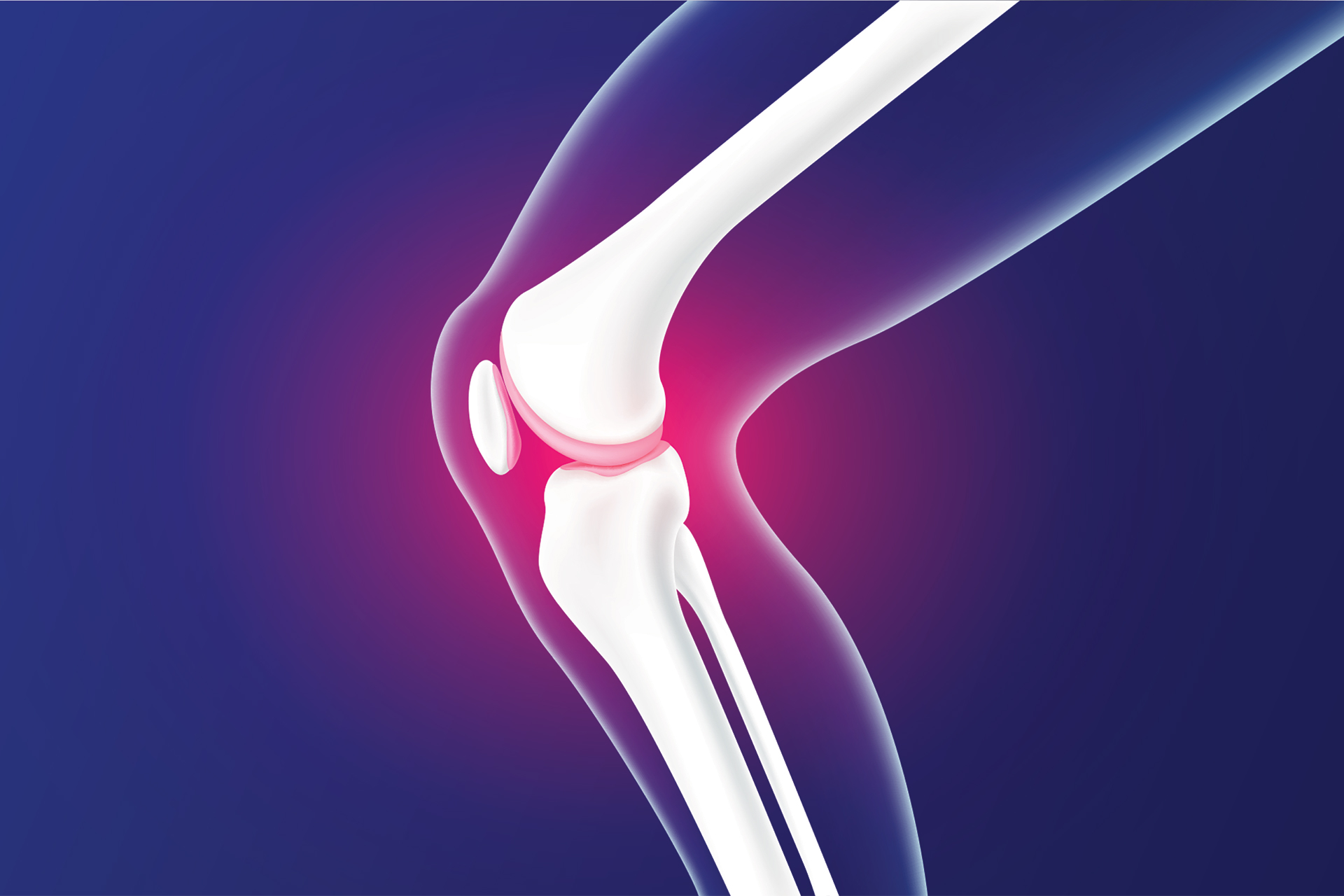A new medical procedure relieves knee pain caused by bone separation
