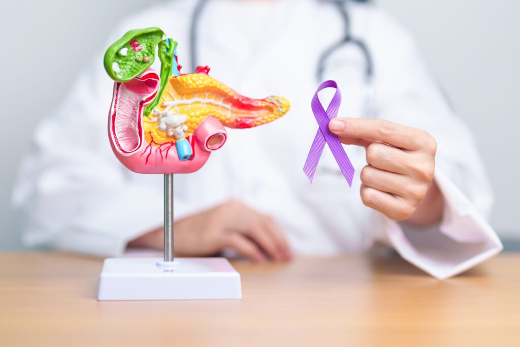 A new way to early detection of pancreatic cancer
