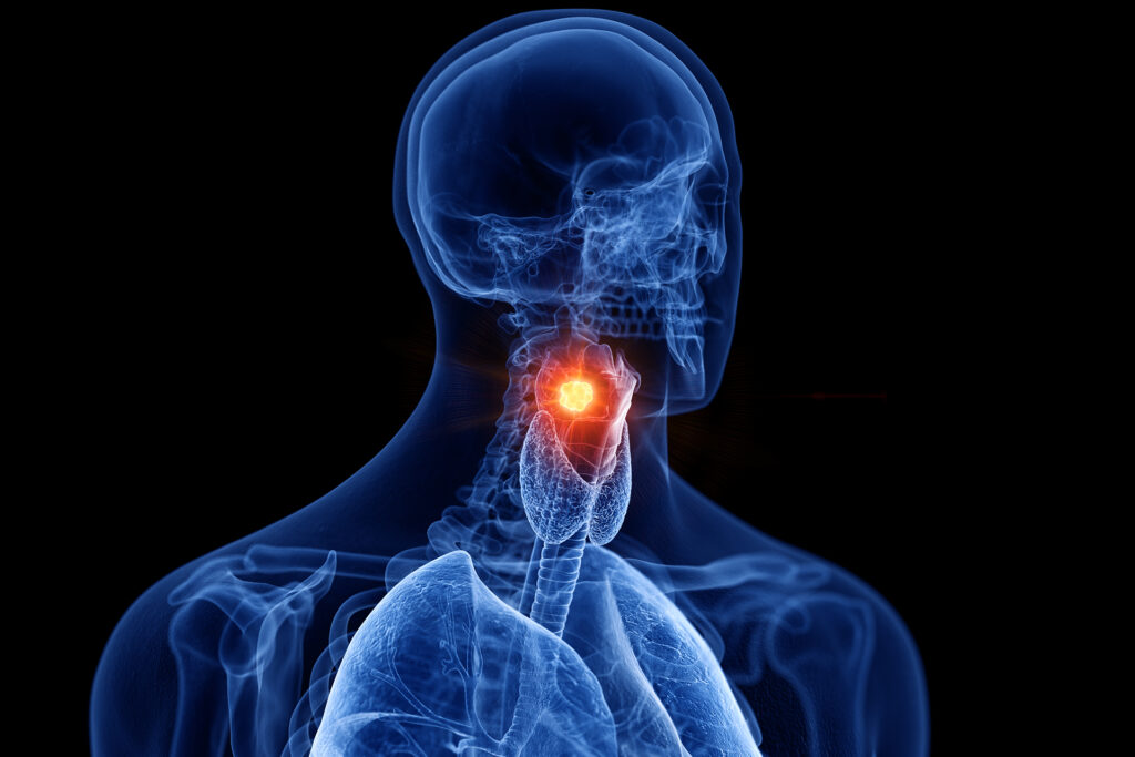 Developing artificial intelligence models for early detection of throat cancer