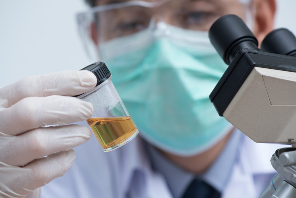 A new way to detect prostate cancer using urine samples