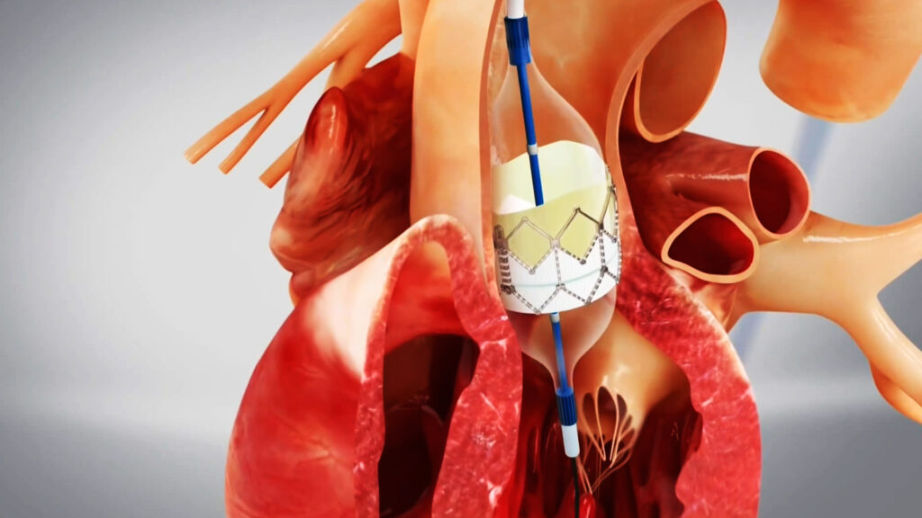 Heart attacks may be caused by a bacterial infection in the arteries