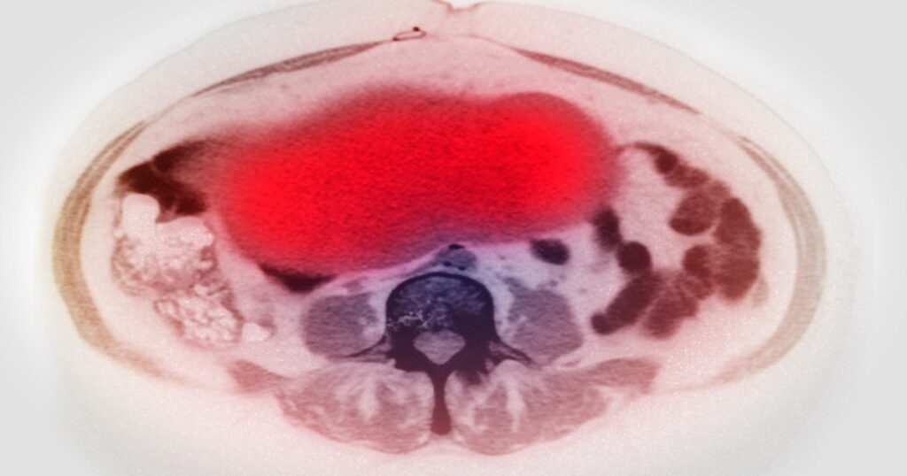 These factors raise the risk of ovarian cancer