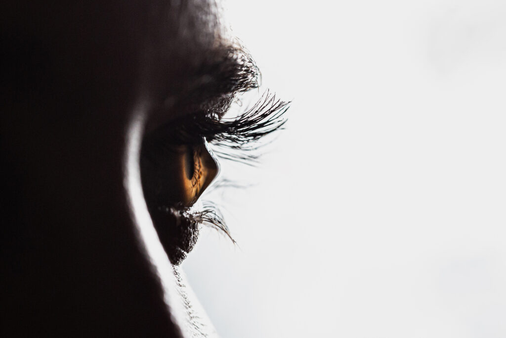 Keratoconus: Rubbing the eyes frequently may contribute to the development of the disease