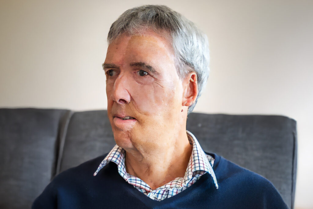 3D printing restores facial features to a British man