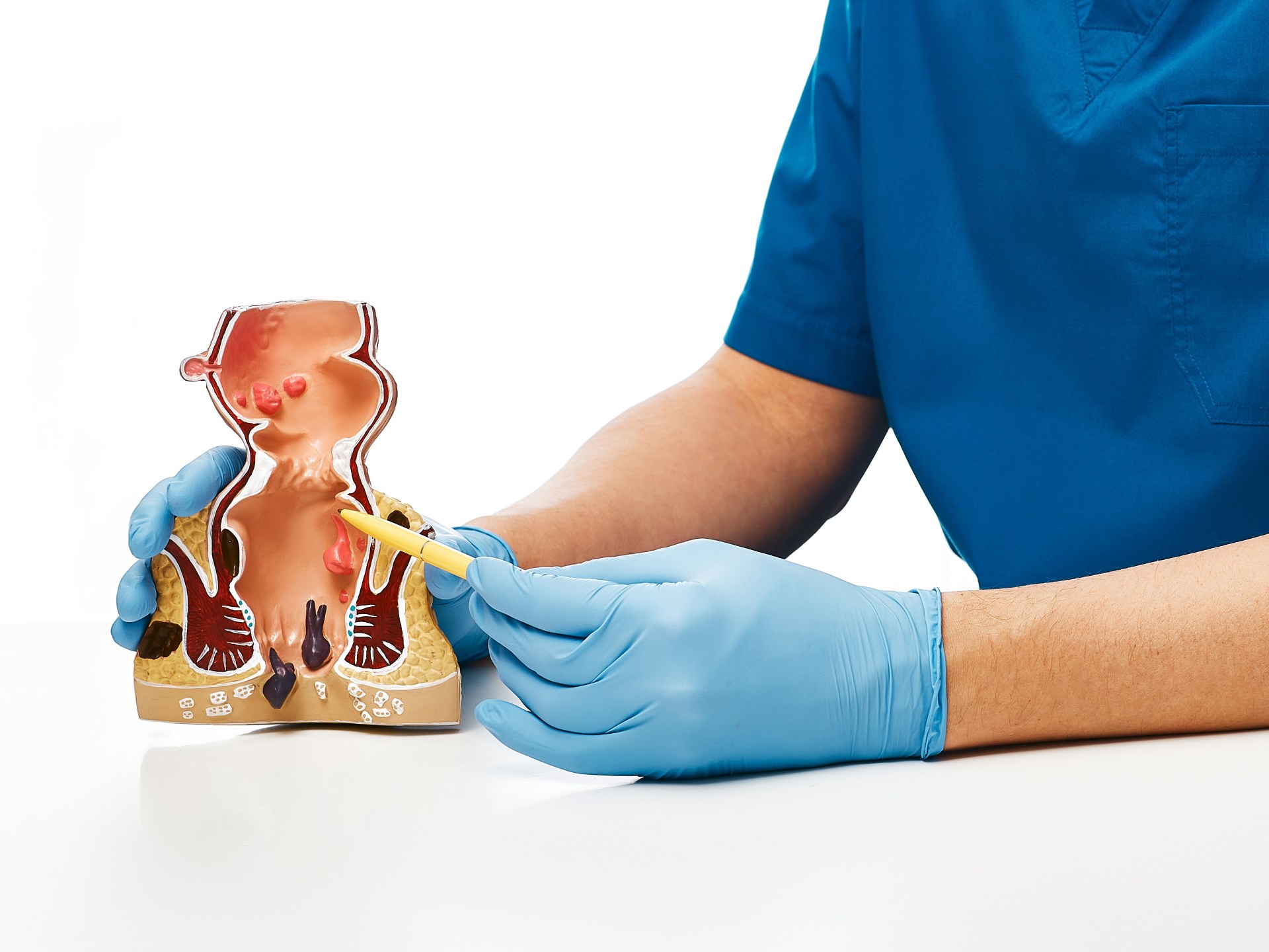 Rectal bleeding indicates the possibility of colon cancer