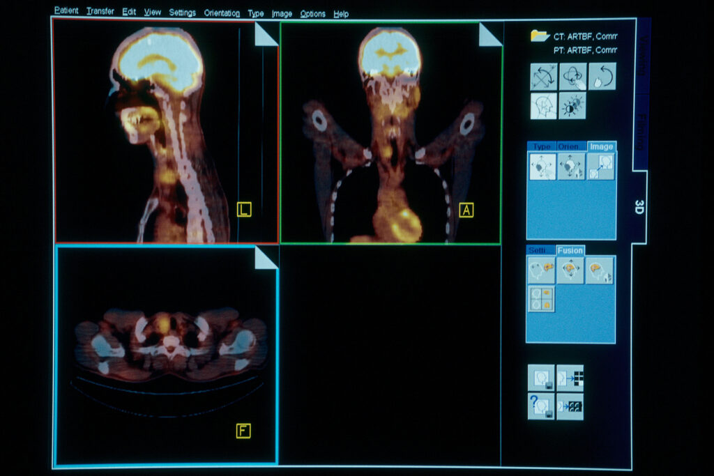 Weight loss injections may affect cancer screenings and cause unnecessary anxiety